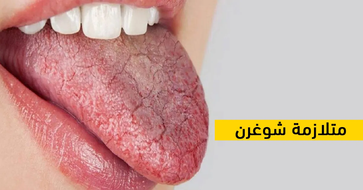 متلازمة شوغرن